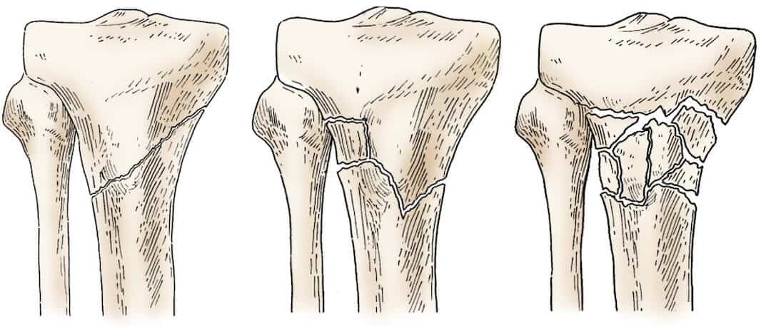 Fractures of Proximal Tibia