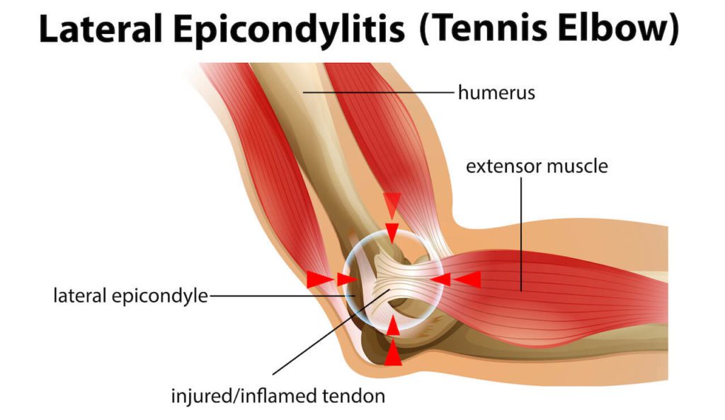 Lateral-Epicondylitis (Tennis Elbow)